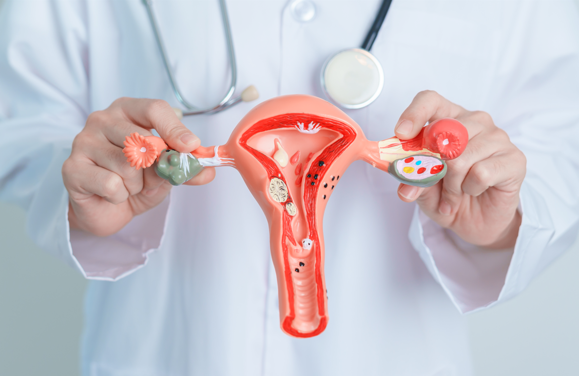 Abril Roxo – Adenomiose afeta milhares de mulheres e ainda é subdiagnosticada no Brasil